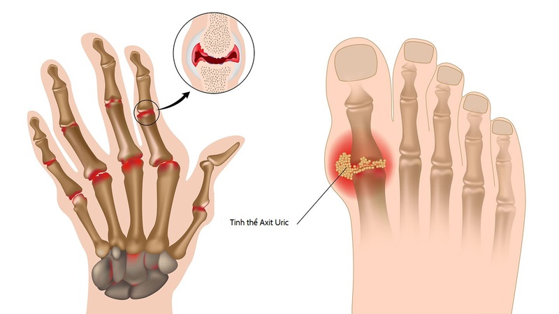 Biểu hiện của bệnh gout bạn cần biết