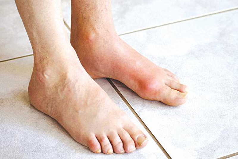 Biểu hiện của bệnh gout bạn cần biết