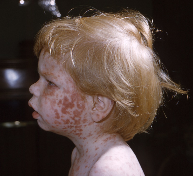 Biểu hiện, triệu chứng cảm cúm rubella 3