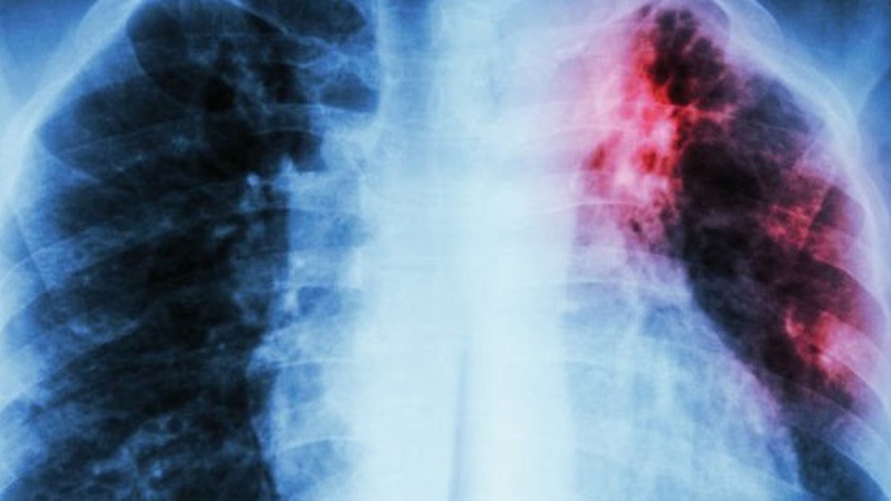 Xơ phổi: Triệu chứng, nguyên nhân và phương pháp điều trị bệnh 1