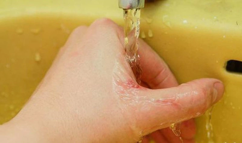 Bố mẹ nên làm gì để sơ cứu khi bé bị rắn cắn 2