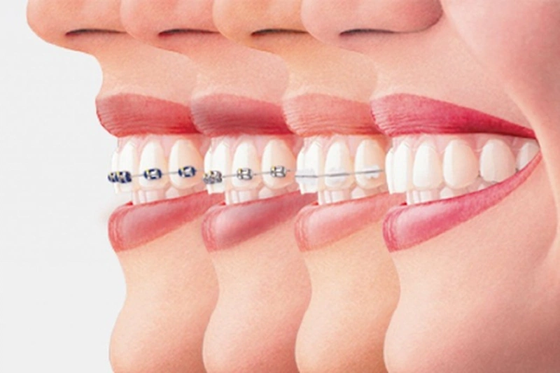 Các bộ niềng răng tại nhà phổ biến hiện nay