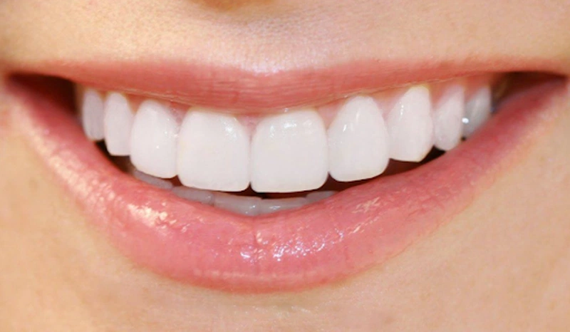 Các bộ niềng răng tại nhà phổ biến hiện nay