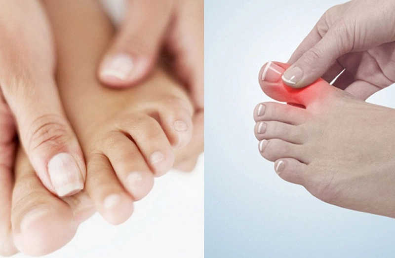 Bỏ túi ngay cách xử lý bong gân ngón chân trỏ nhanh khỏi và hiệu quả nhất 1