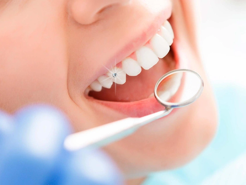 Bọc răng sứ có bị rơi ra không? Những lưu ý khi chăm sóc răng sứ 2