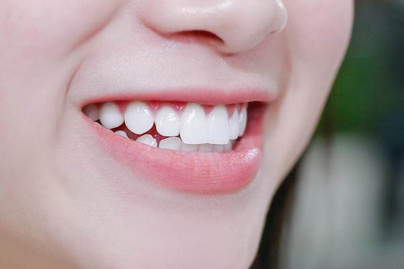Góc tìm hiểu: Nên niềng răng hay bọc sứ tốt hơn? 3