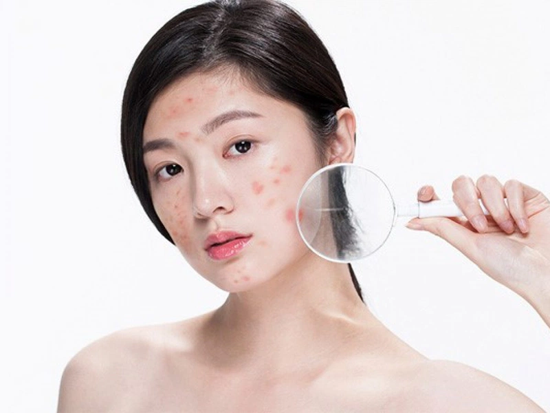 Thời gian để hết mụn và thâm còn tùy thuộc vào loại mụn bạn gặp phải và mức độ thâm nám của da
