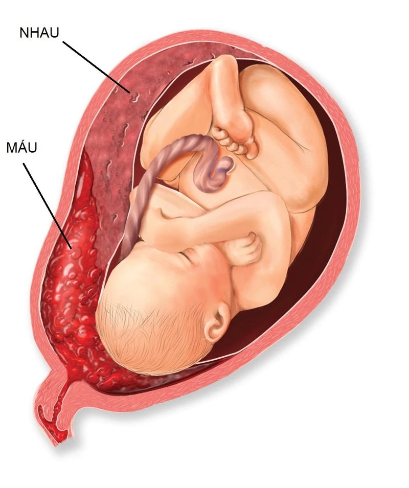 Bốn cấp độ trưởng thành của nhau thai và làm sao phòng tránh canxi hóa bánh nhau sớm