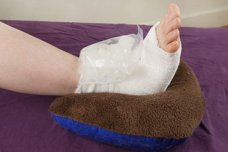 Bong gân bàn chân bao lâu thì khỏi và nên xử lý như thế nào? 4