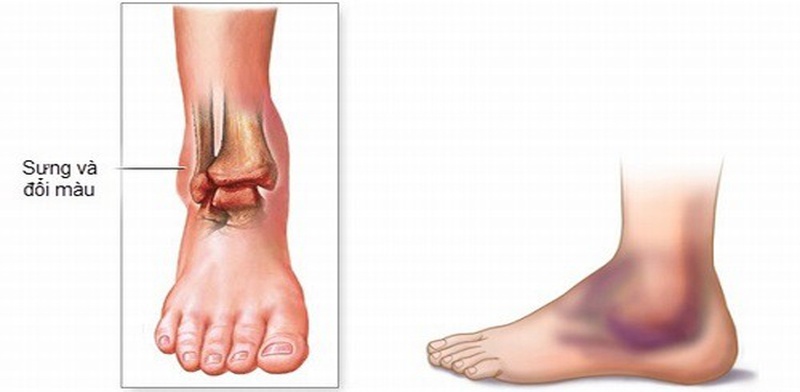 Bong gân chân là hệ quả của việc té ngã lúc vận động hay chơi thể thao, hoặc do tai nạn bất ngờ gây ra