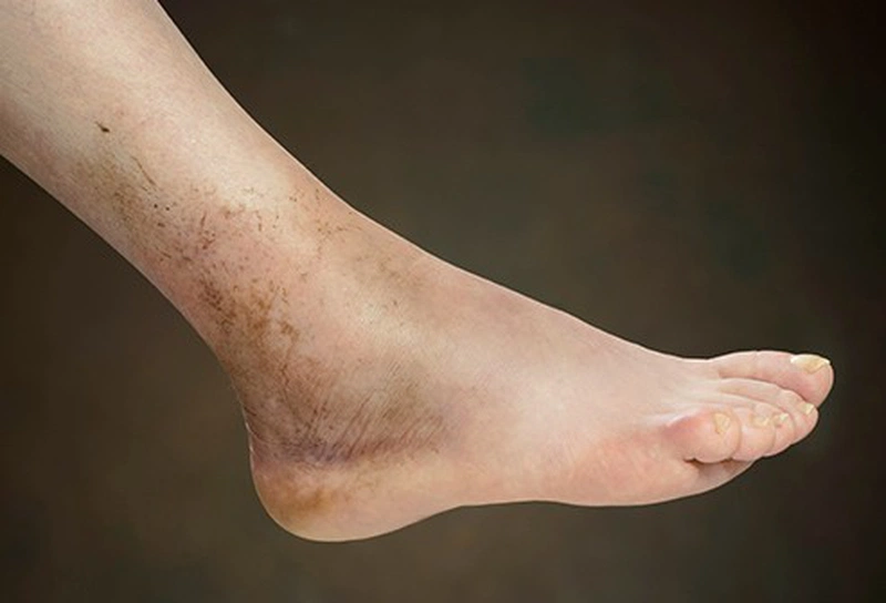Bong gân chân đắp lá gì để mau lành 2