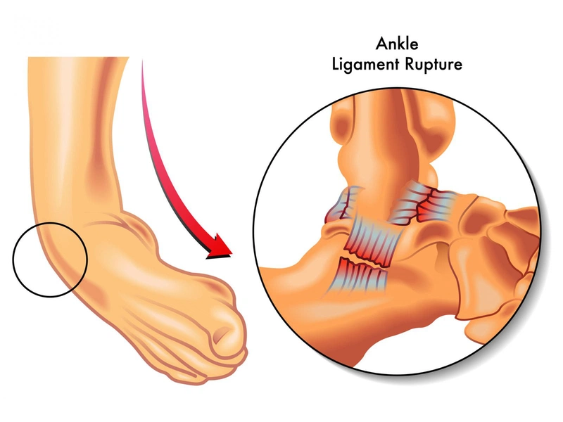 Bong gân cổ chân là tình trạng các dây chằng liên kết các khớp ở cổ chân bị kéo giãn quá mức