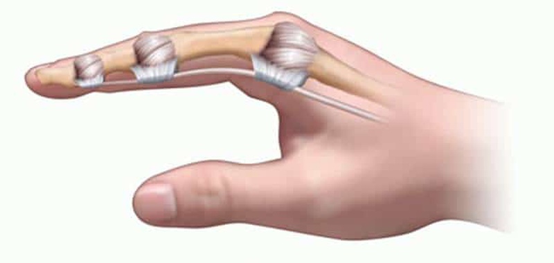 Bong gân ngón trỏ tay: dấu hiệu, nguyên nhân và cách điều trị mau khỏi  3
