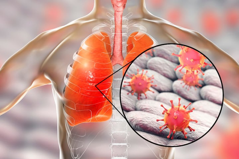 Bùng phát dịch viêm phổi nghi do SARS 3
