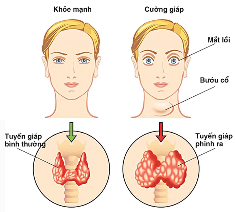 Bướu cổ gây lồi mắt có thể bị mù vĩnh viễn hay không? Làm thế nào để điều trị?  3