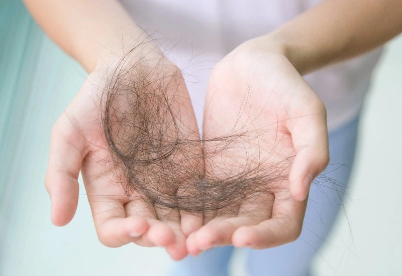 Bướu cổ gây rụng tóc: Nguyên nhân, giải pháp khắc phục hiệu quả tình trạng rụng tóc 1