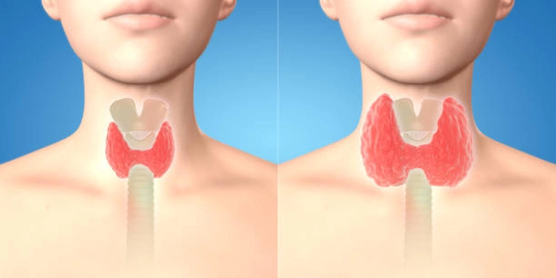 Bướu cổ lan tỏa: Phân loại, triệu chứng và cách điều trị 3