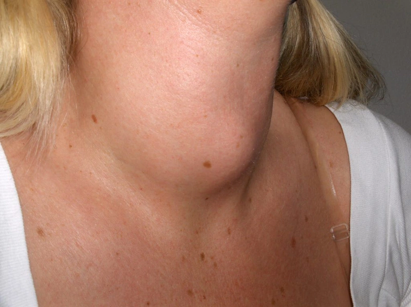 Bướu cổ phải xạ trị cần lưu ý những vấn đề gì 1