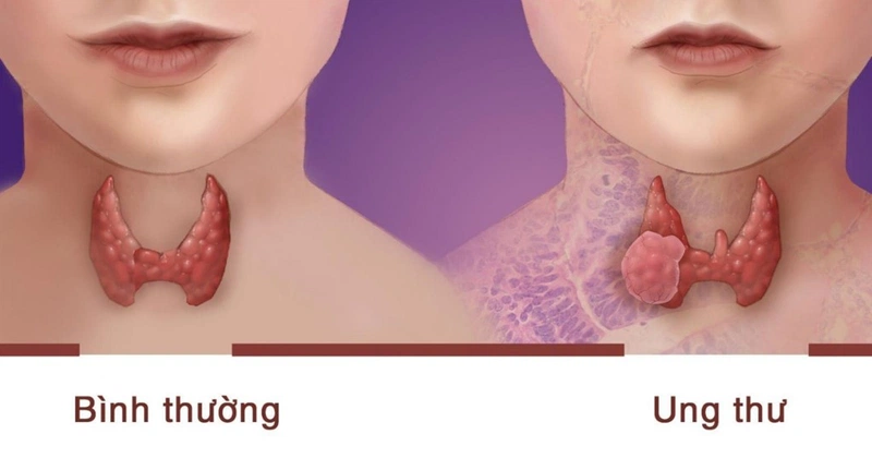 Bướu cổ tuyến giáp là gì? Có nguy hiểm không? Cách phòng tránh 3