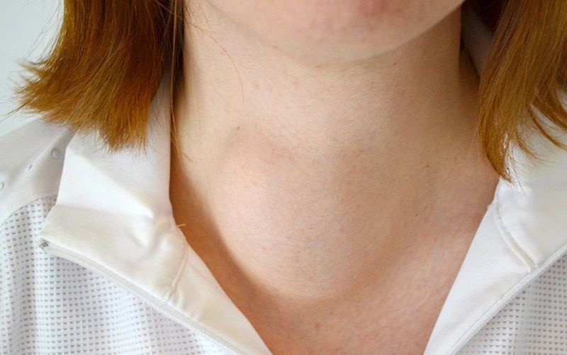 Bướu cổ vô sinh: Quan niệm mà nhiều người lầm tưởng bấy lâu! 1