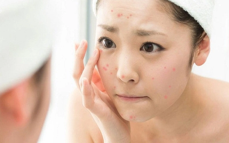 Da mặt bị dị ứng bụi vải, bụi bẩn, nguyên nhân và cách xử lý 2