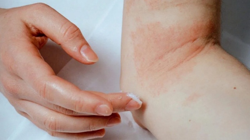 Cà chua xanh chữa viêm da cơ địa có hiệu quả không? 2