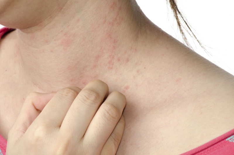 Các bệnh dị ứng ngoài da: Nguyên nhân và dấu hiệu nhận biết