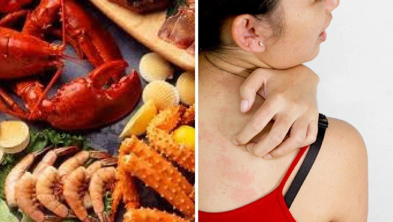 Các bệnh dị ứng thường gặp và dấu hiệu nhận biết