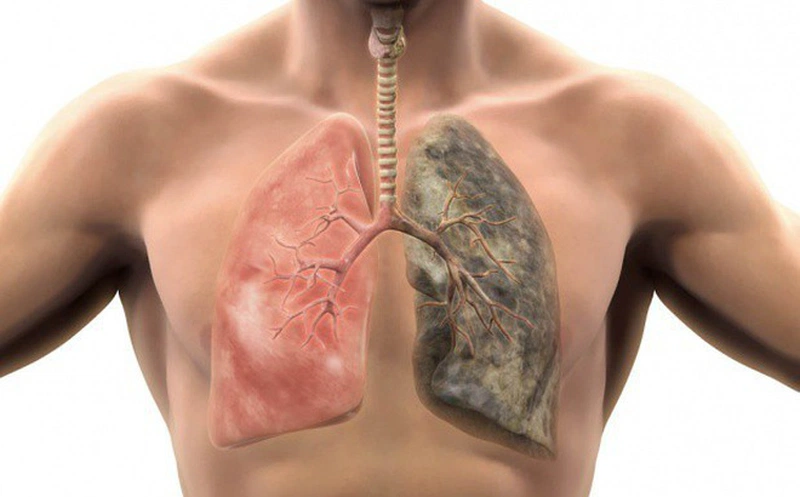 Các bệnh lý về phổi? Phương pháp phẫu thuật phổi hiệu quả 1