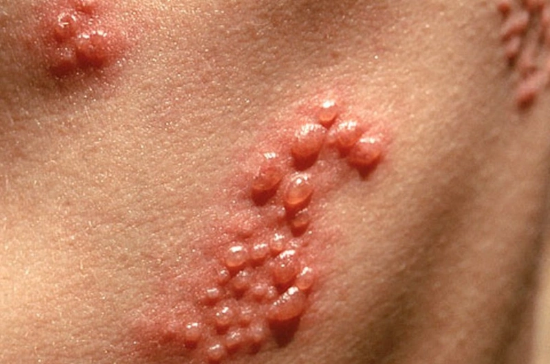 Bệnh zona là một trong các bệnh ngoài da thường gặp hiện nay