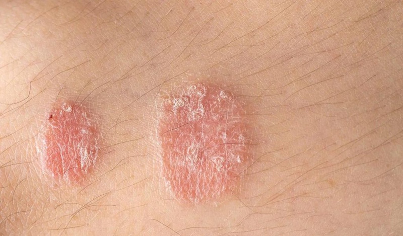 Các bệnh ngoài da thường gặp ở người lớn cần biết để phòng tránh 3