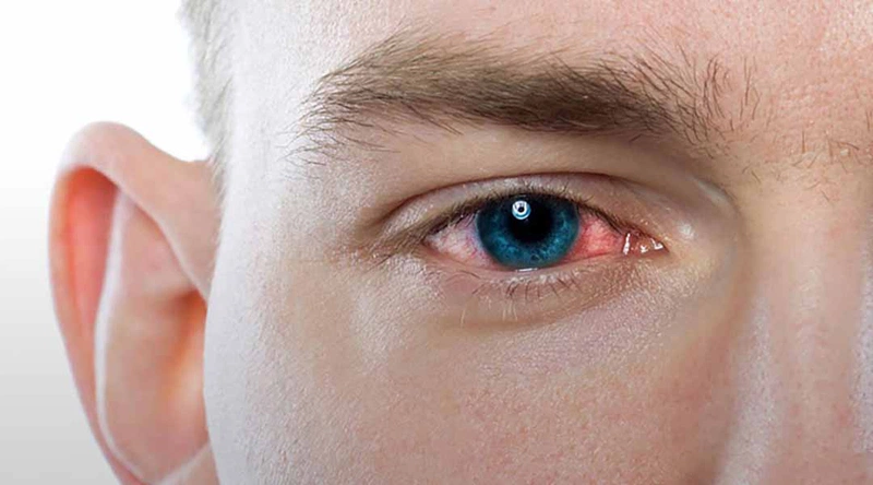 Các bệnh nhiễm trùng mắt và cách phòng ngừa 2