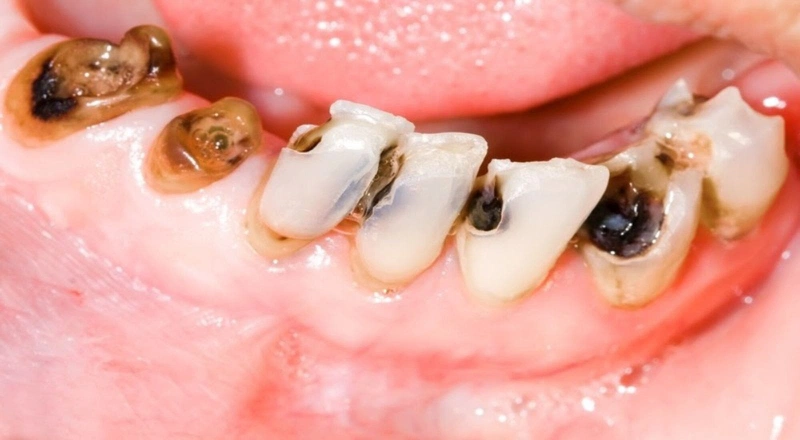 Các bệnh răng miệng nguy hiểm thường gặp 2
