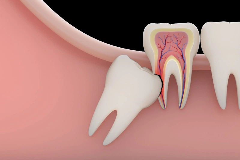 Các bệnh răng miệng nguy hiểm thường gặp 3