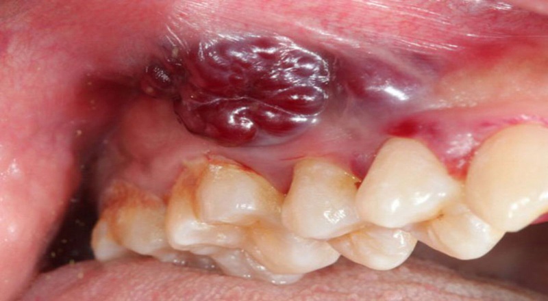 Các bệnh răng miệng nguy hiểm thường gặp 4