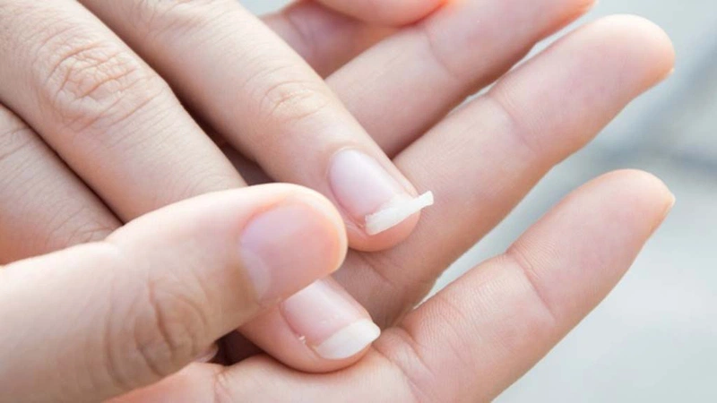 Các bệnh về móng tay phổ biến bạn không nên xem thường