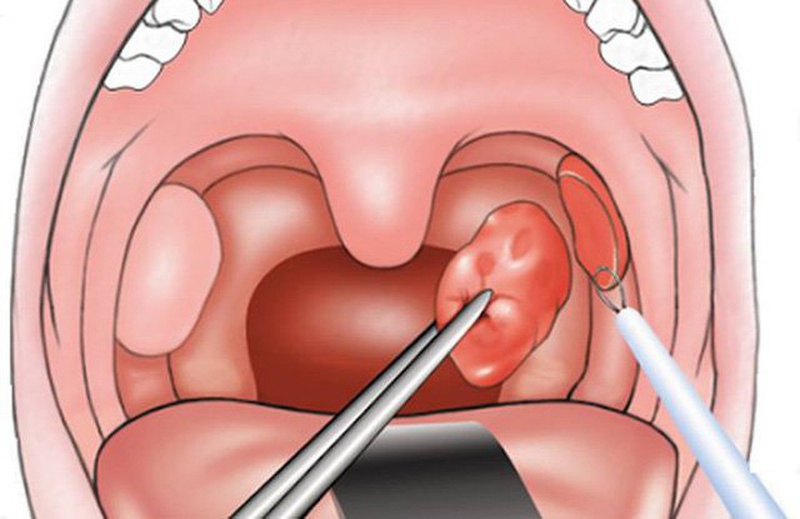 Các biện pháp điều trị viêm amidan nhẹ và nặng