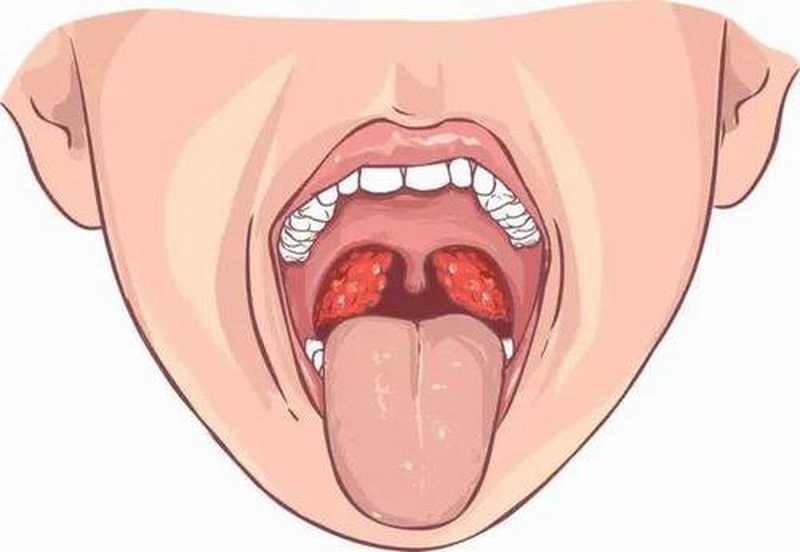 Các biện pháp điều trị viêm amidan nhẹ và nặng