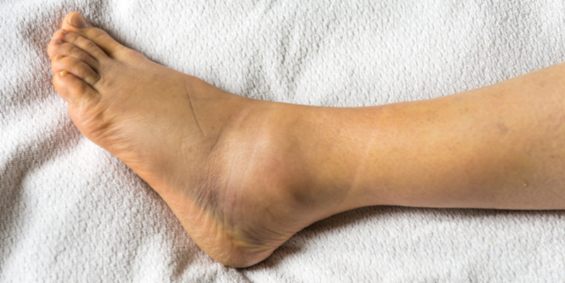 Tình trạng bong gân mắt cá chân thường dẫn đến bầm tím trên da