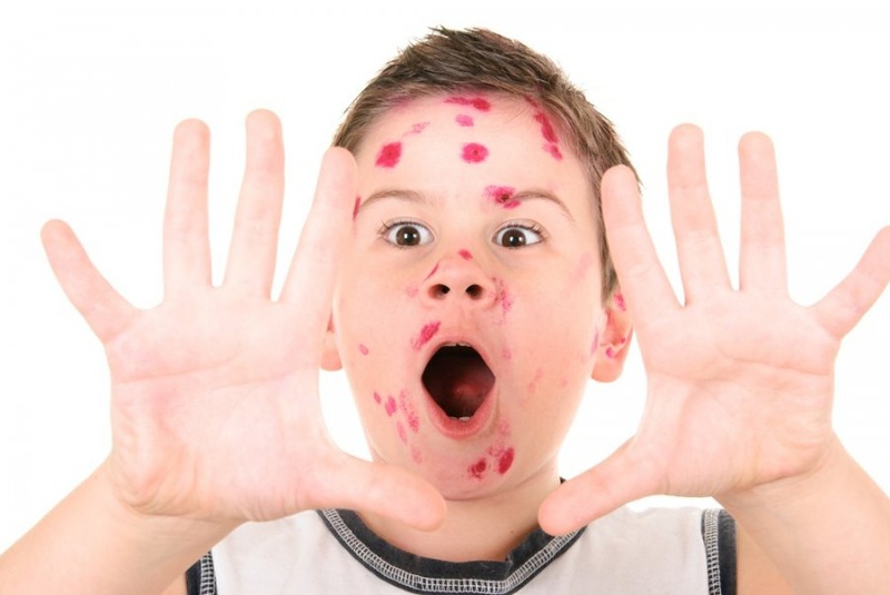 Các dấu hiệu của bệnh thủy đậu bạn cần biết càng sớm càng tốt