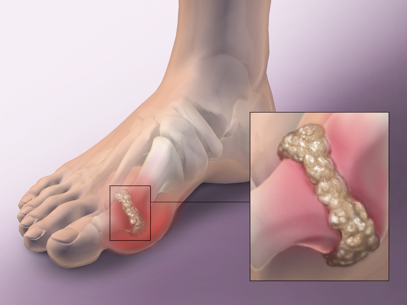 Các giai đoạn của bệnh gút