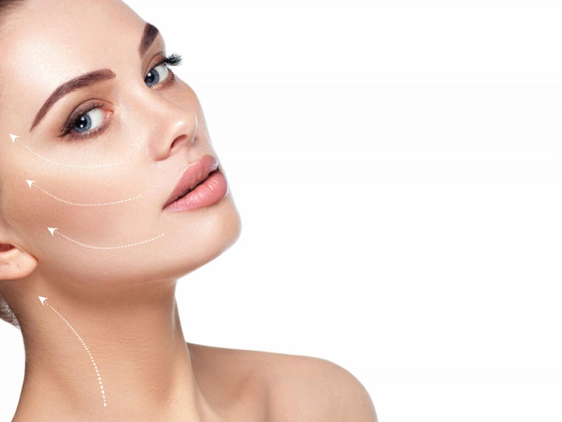 Chỉ căng da mặt S-Soft là một trong những dòng chỉ nâng cơ mặt đem hiệu quả làm đẹp cao