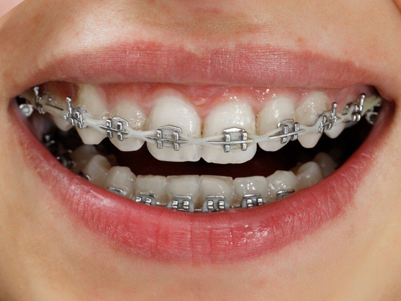 Mắc cài kim loại truyền thống là loại mắc cài được sử dụng phổ biến nhất