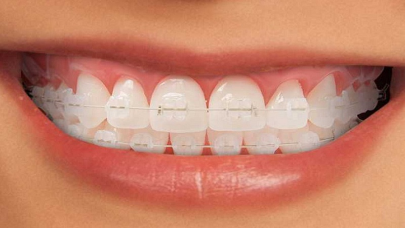 Mắc cài sứ rất thẩm mỹ vì mắc cài có màu giống màu răng thật, khó nhận thấy trong quá trình giao tiếp