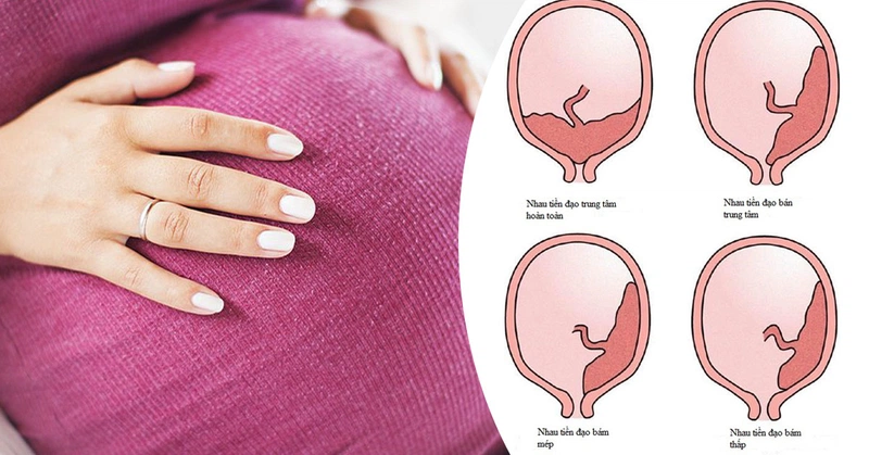 Các loại rau tiền đạo thường gặp ở bà bầu. Dấu hiệu nhận biết bị rau tiền đạo là gì? 1