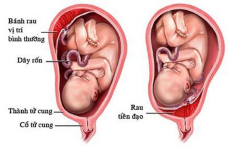 Các loại rau tiền đạo thường gặp ở bà bầu. Dấu hiệu nhận biết bị rau tiền đạo là gì? 2
