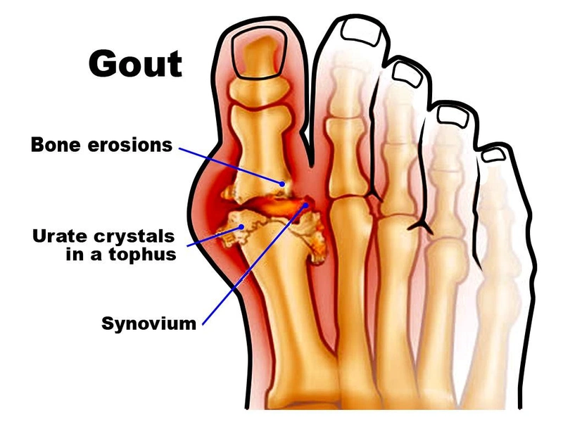 Các loại thuốc giảm đau gout cấp hiệu quả nhanh chóng 2