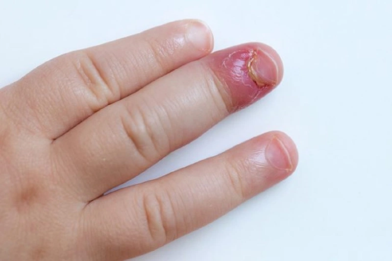 Các loại thuốc mỡ bôi chín mé nhằm điều trị chín mé hiệu quả 3