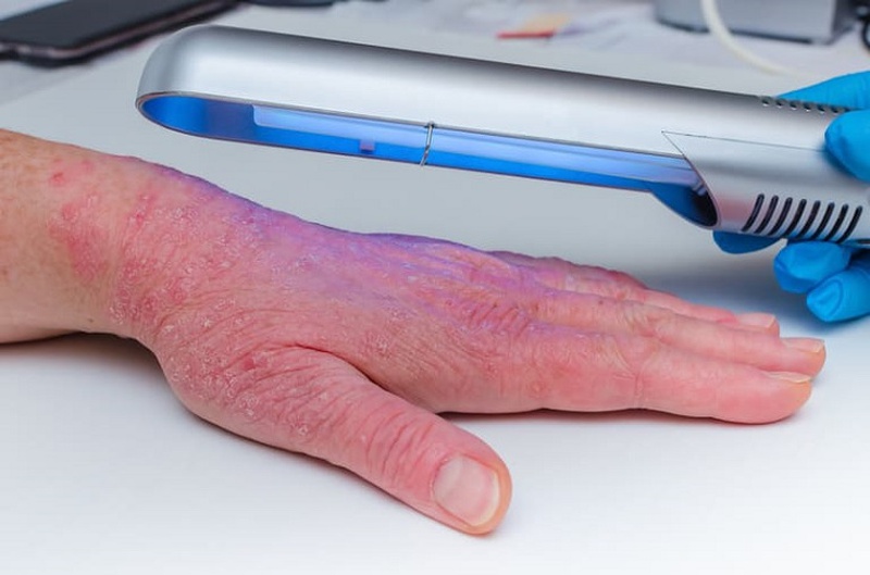 Phương pháp chiếu tia cực tím có thể giúp ngăn chặn sự phát triển nhanh của các tế bào da