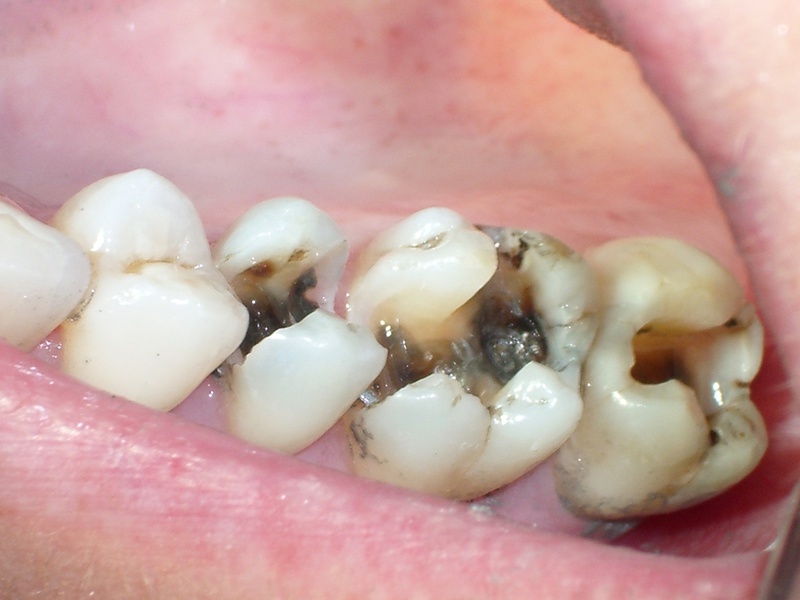 Nguyên nhân đau răng hàm: sâu răng
